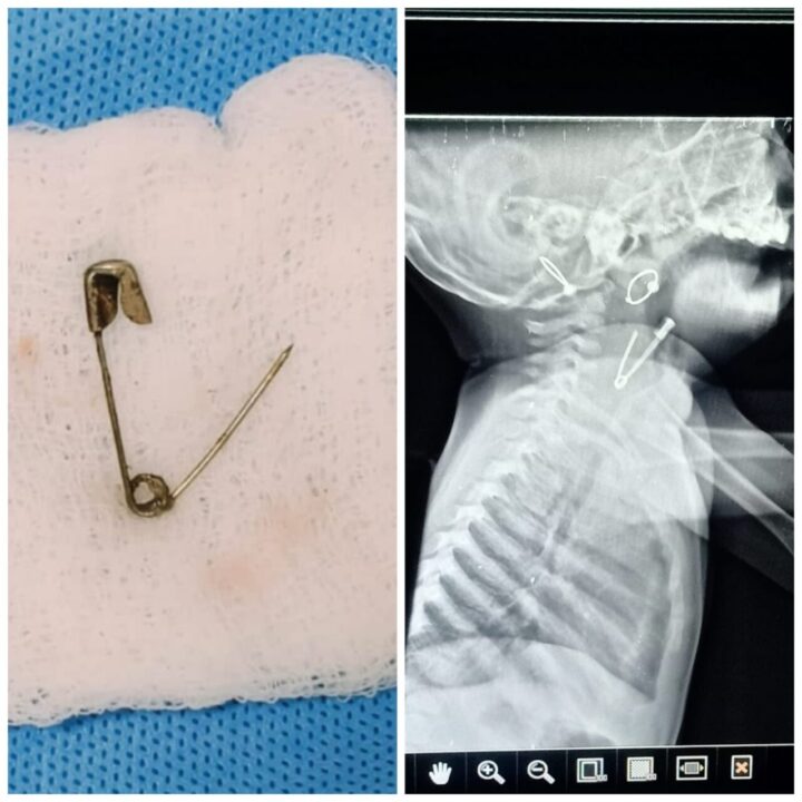 वालावलकर हॉस्पिटल, डेरवणमध्ये यशस्वी शस्त्रक्रिया ; चिमुकलीच्या घशात अडकलेली सेफ्टी पिन बाहेर